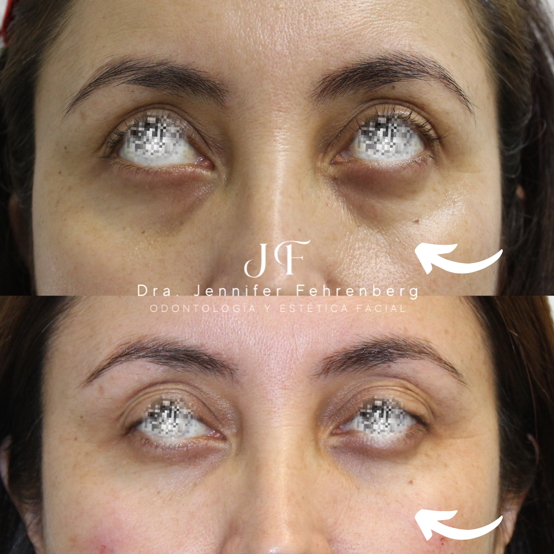 Tratamiento de Ojeras