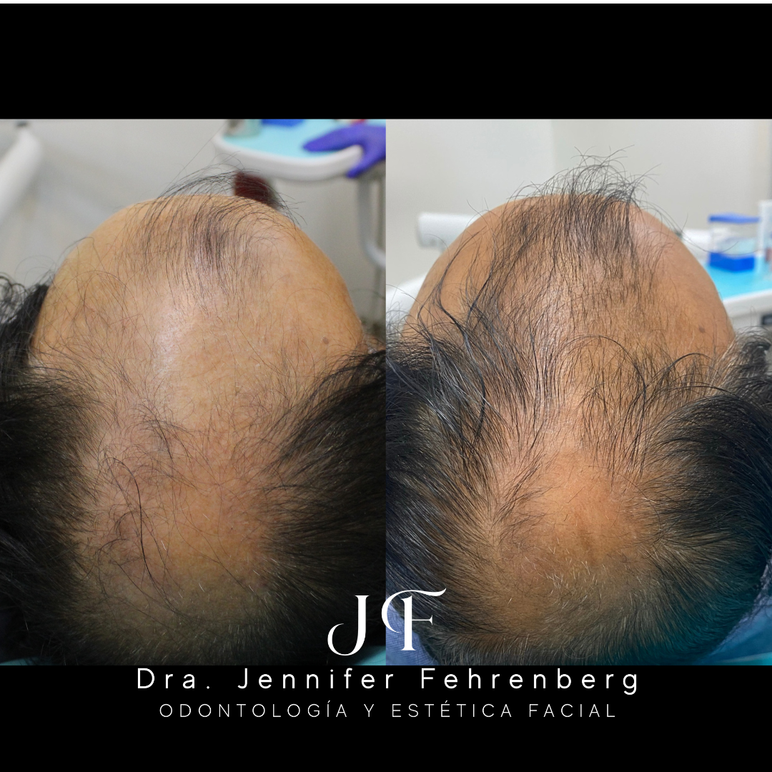 Terapia Capilar PRP