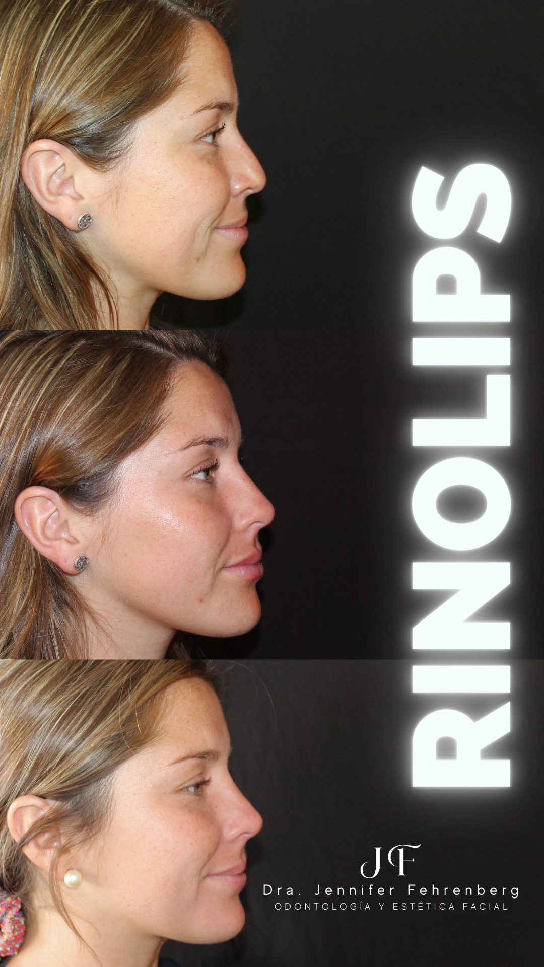 Rinolips Combinado